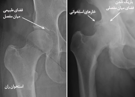 تشخیص آرتروز لگن